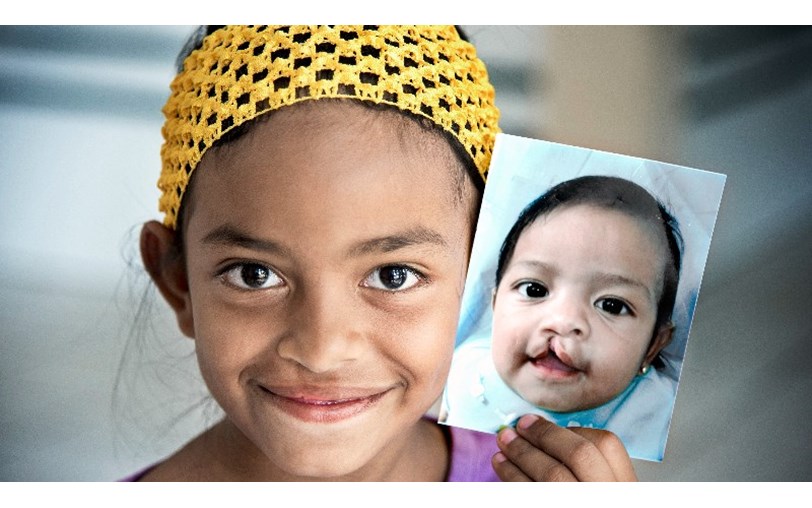 cleft lip and palate before and after operation smile